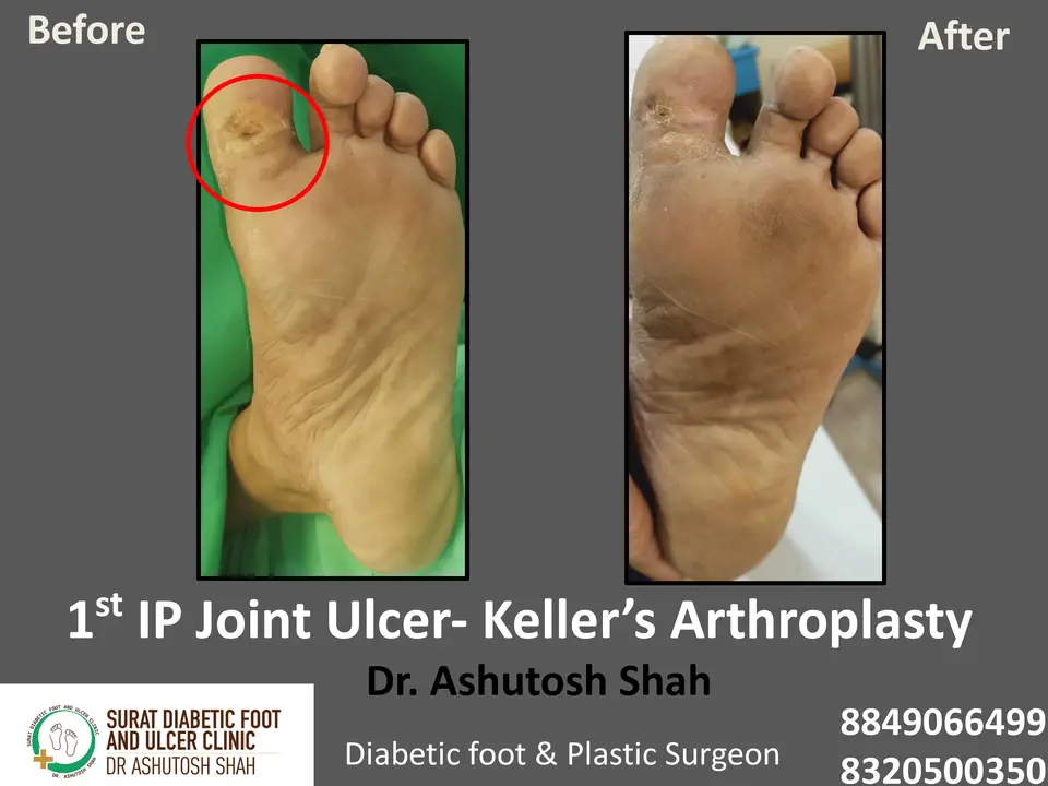 Diabetic Foot  PPT 3 checked by sir.pptx-25.webp